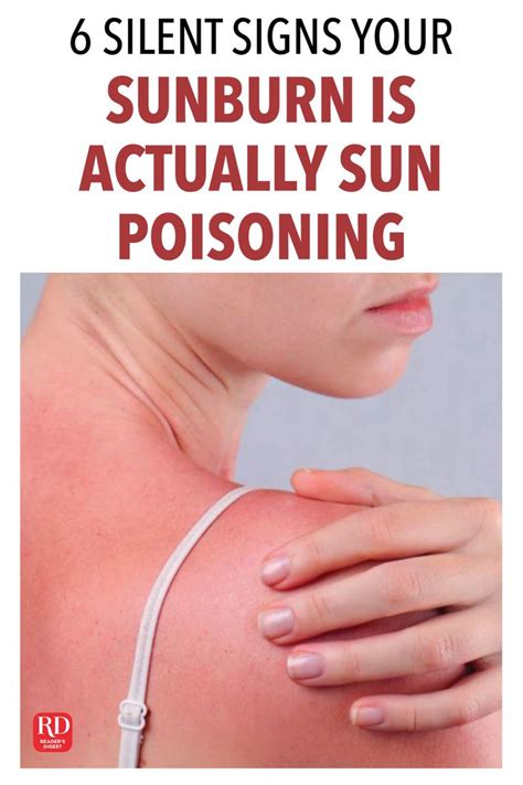 sunburn weeping|Here’s How to Tell If You Have a Sunburn or Sun Poisoning